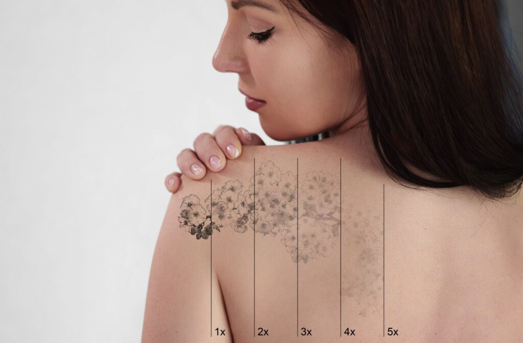 Progress of tattoo fading with laser tattoo removal treatment