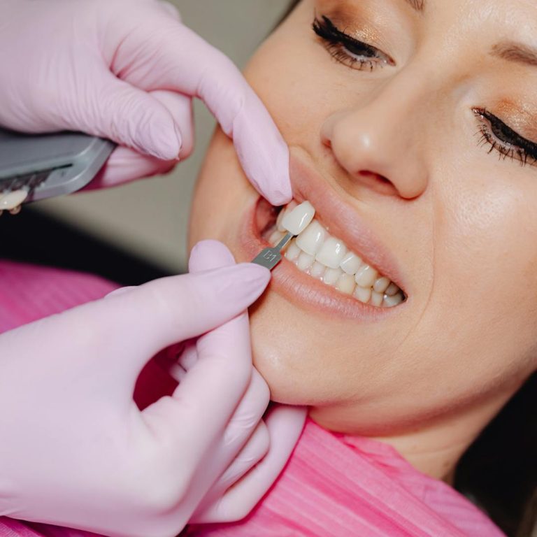Close-up of a dental veneer being applied to a woman's teeth at a clinic.