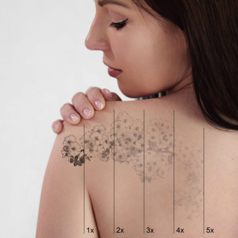 Progress of tattoo fading with laser tattoo removal treatment