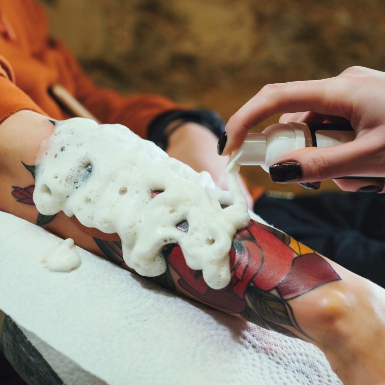 Antiseptic foam wiped off hand during final stage of laser tattoo removal treatment.